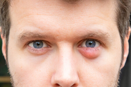 Stye-vs.-Chalazion-First-Eye-Care-DFW-scaled.jpg