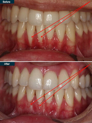 Periodontal-Gum-Disease-Treatment-NYC-Periodontist.jpg