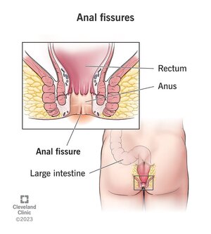 13177-anal-fissures.jpg