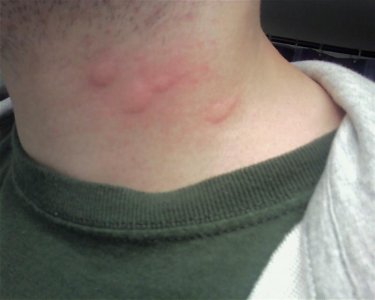 hives.jpg