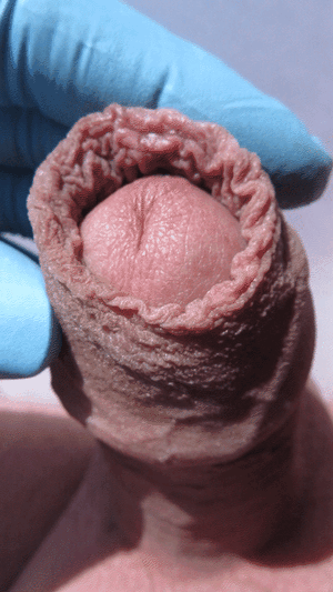 Pre-circumcision_exam.gif
