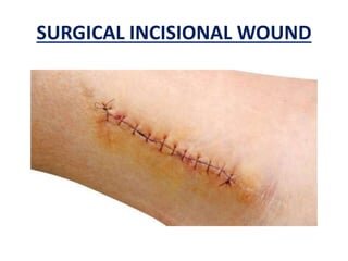classification-of-wounds-21-320.jpg