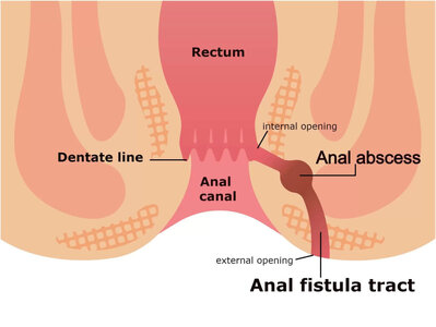 anal-fistula-diagram-1024x770.jpg