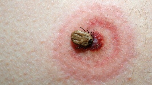 bug-bite-guide-tick-bites-722x406.jpg