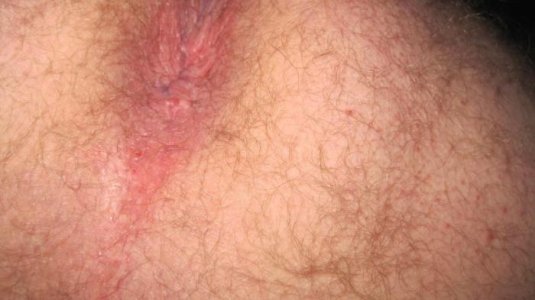 Me in June 2013 my hole.jpg